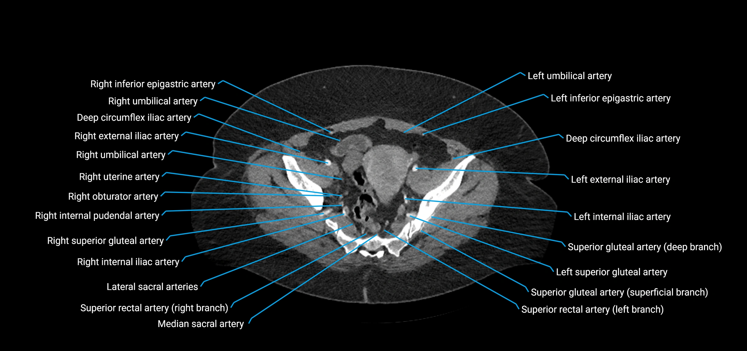 CTA abdomen axial cross sectional anatomy labelled image_212 (2).webp
